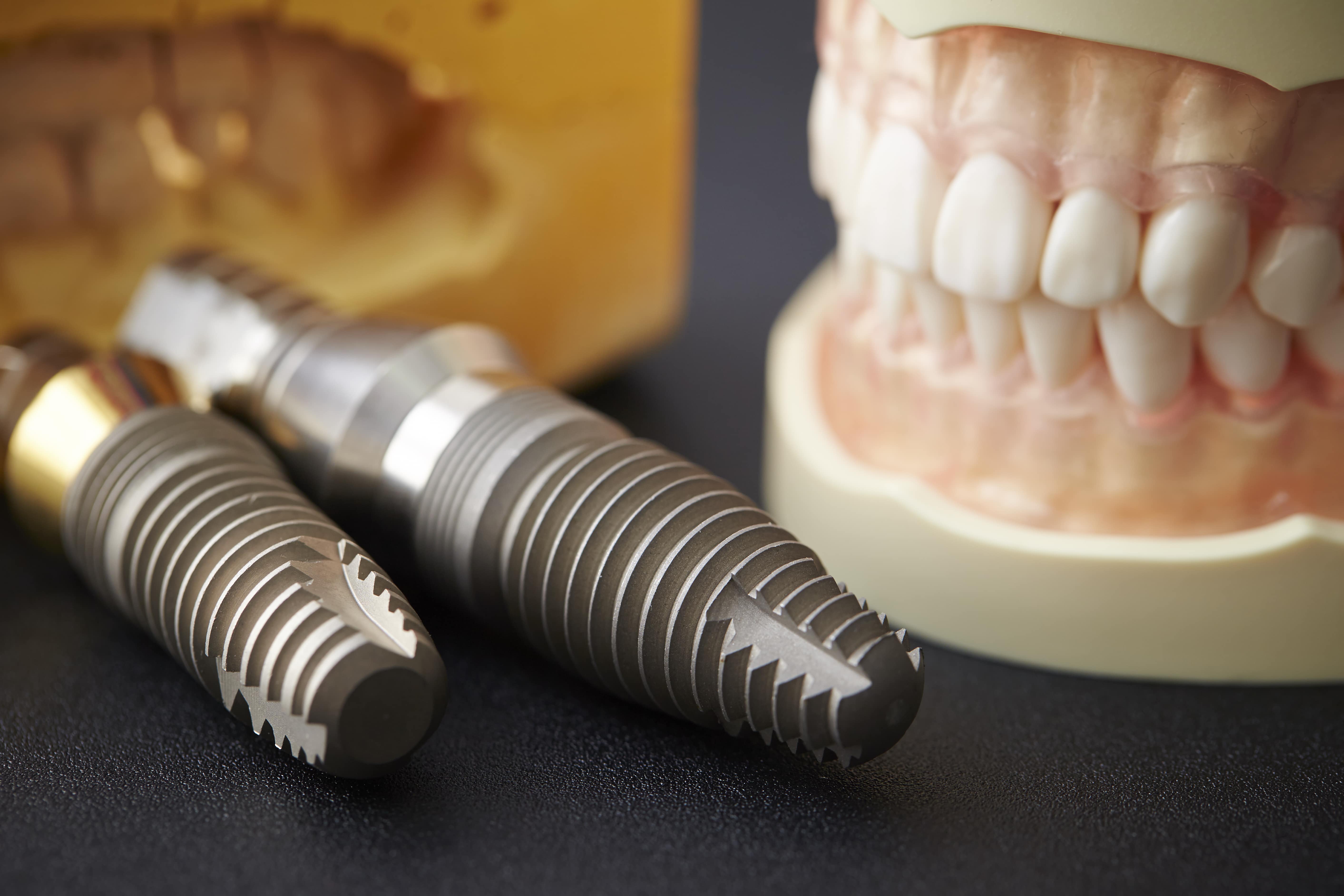 Houston Dentist Provides Implant (And Removable) Full And