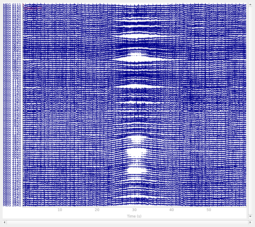 Overview of artifact detection — MNE 1.2.2 documentation