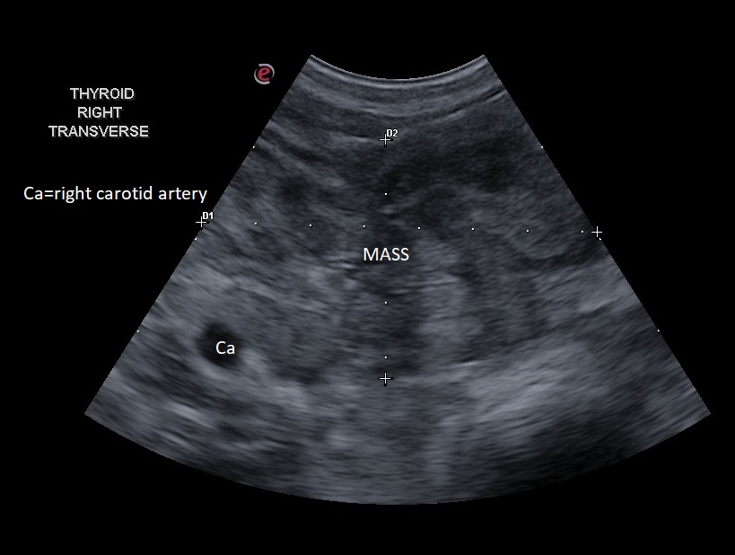 Canine Thyroid Carcinoma Minnesota Veterinary Ultrasound