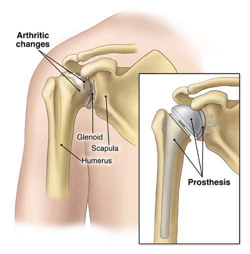 Shoulder Joint Replacement And Rehabilitation Mobile Physiotherapy Clinic