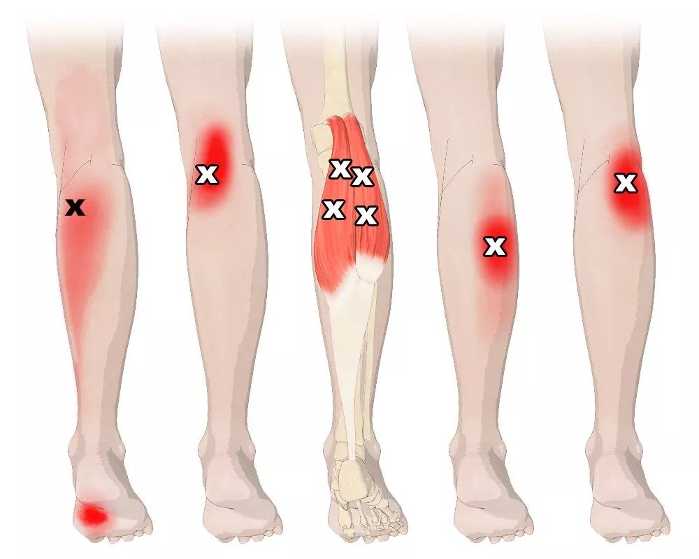Trigger point calf Cause, Symptoms, Treatment Mobile Physio