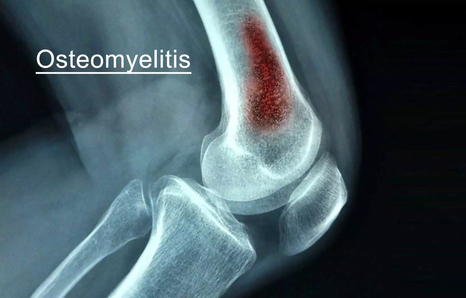 Osteomyelitis Type, Cause, Symptoms, Treatment Mobile Physio