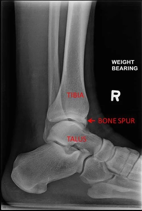 Ankle Bone Spur Cause, Symptoms, Treatment