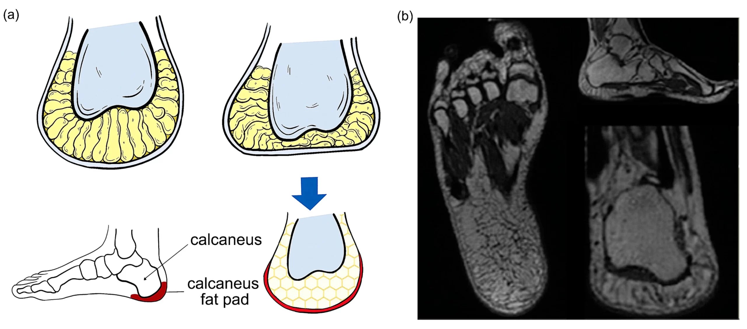 Heel Fat Pad Syndrome (HFPD) Cause, Symptoms, Treatment