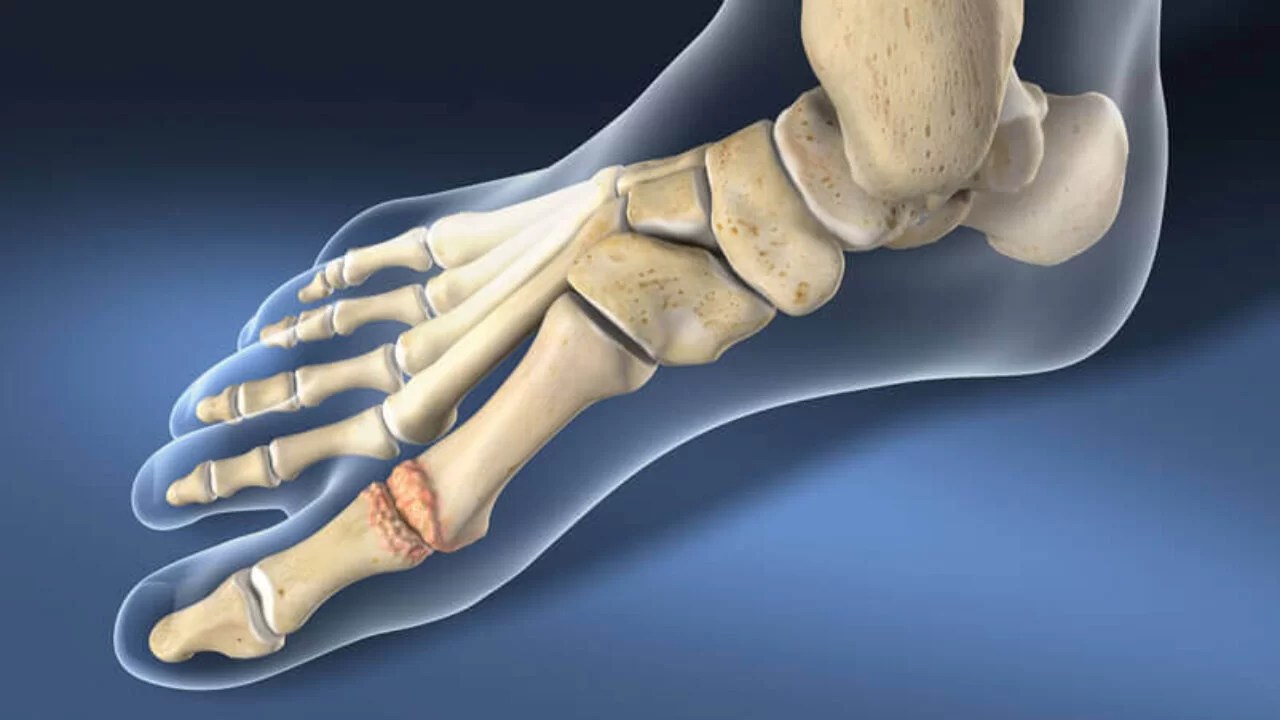 Hallux rigidus Cause, Symptoms, Treatment, Exercise