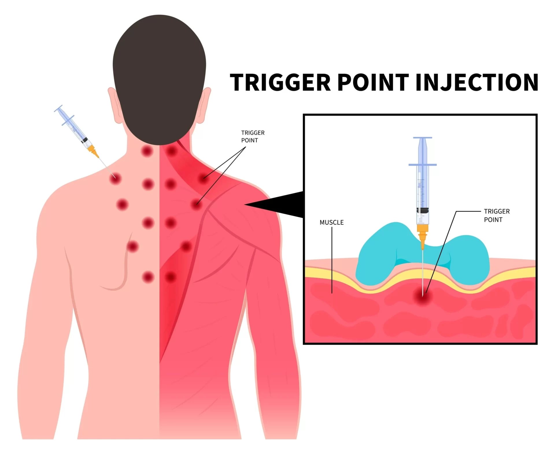 Trigger Point Injection Purpose, Procedure, Technique