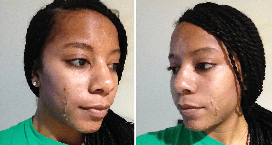 My First Chemical Peel Review with Pictures Mocha Girls Pit Stop