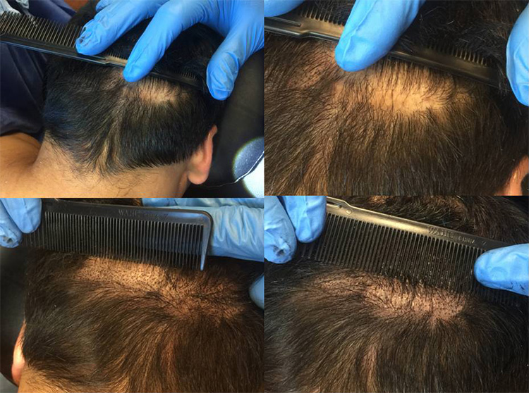 How to Conceal Hair Transplant Scars Modena Hair Institute