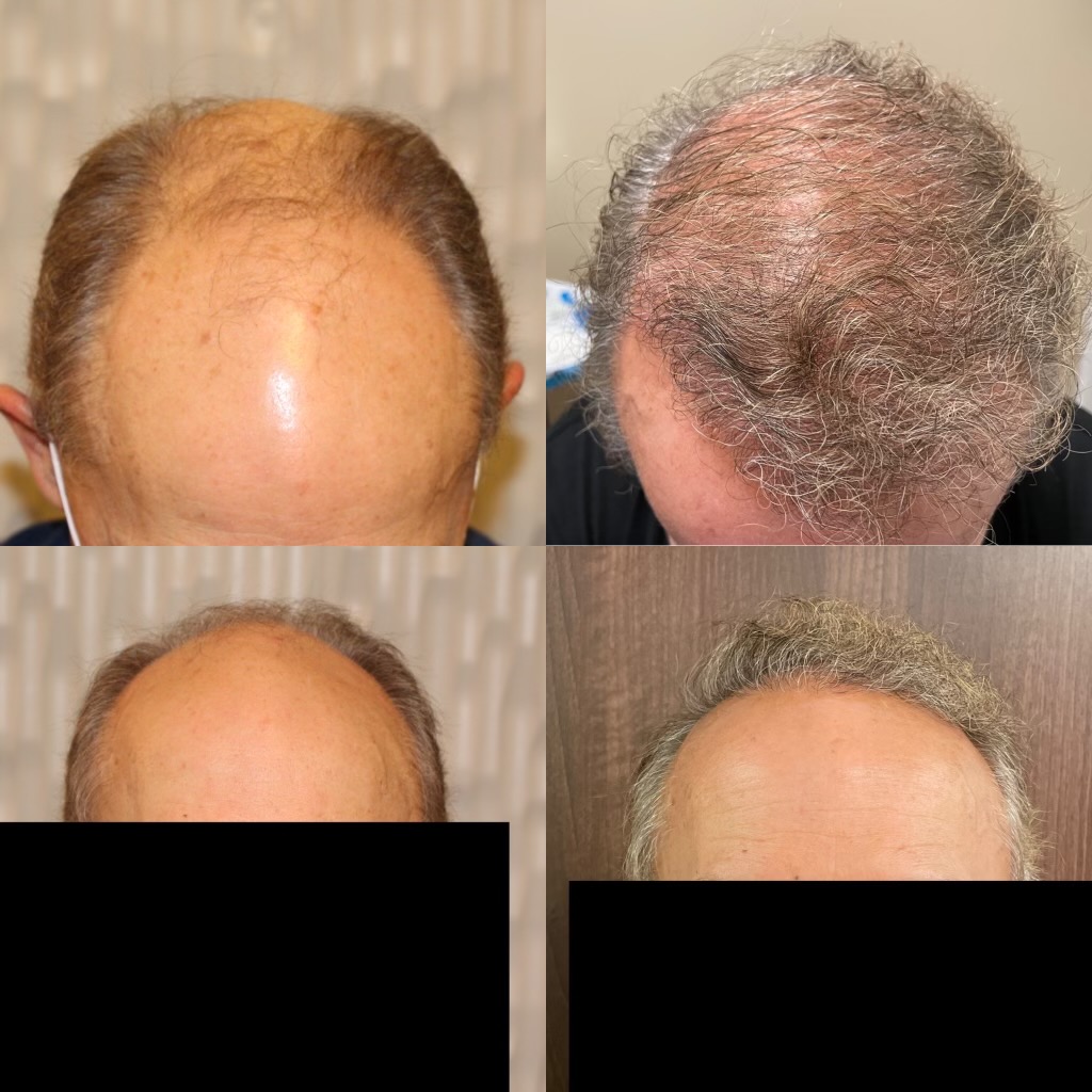 Norwood 7 Hair Restoration 59 year old 3,700 Grafts