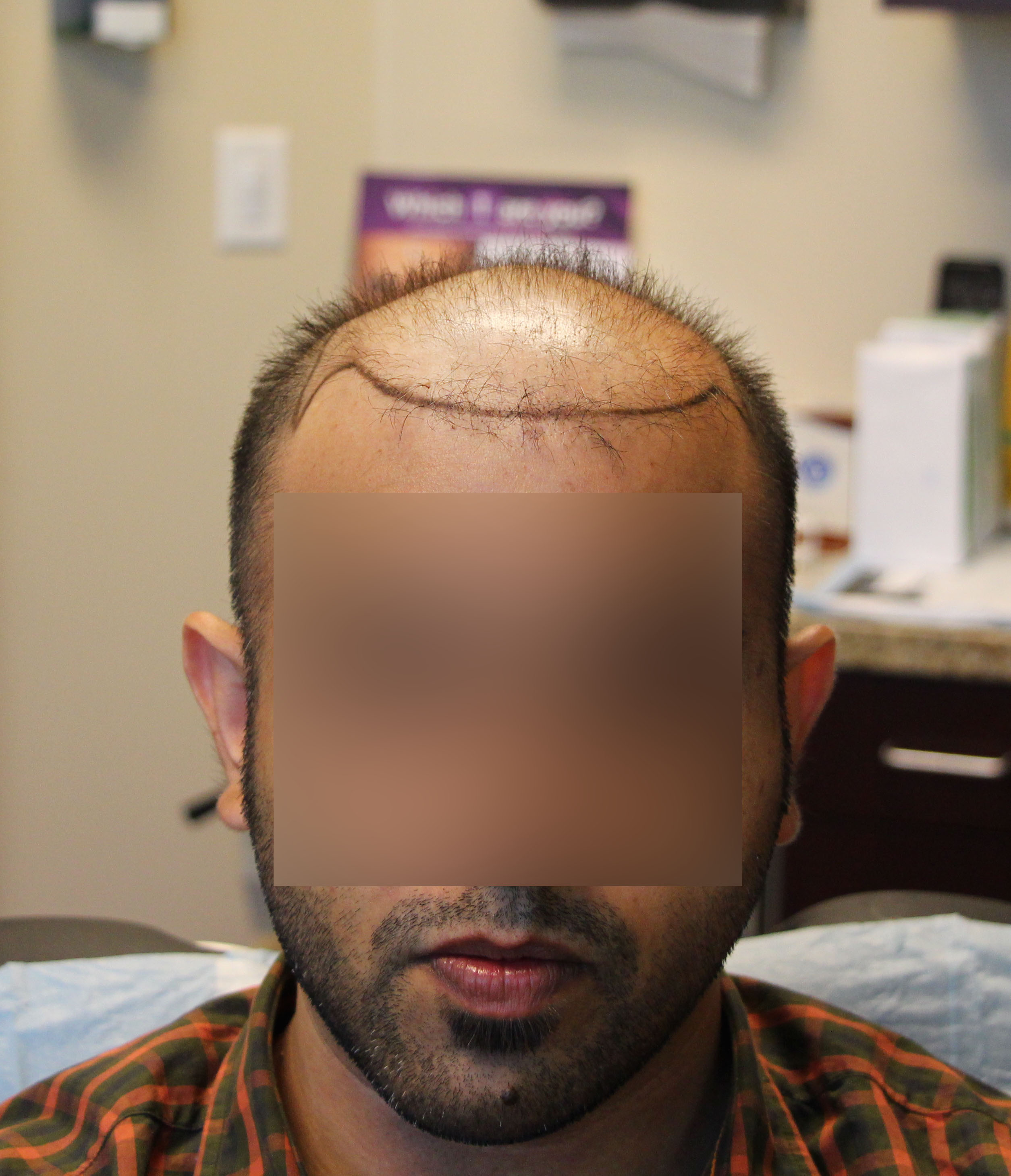 Botched Hair Transplant Repaired By Dr. Yazdan Modena Hair Institute