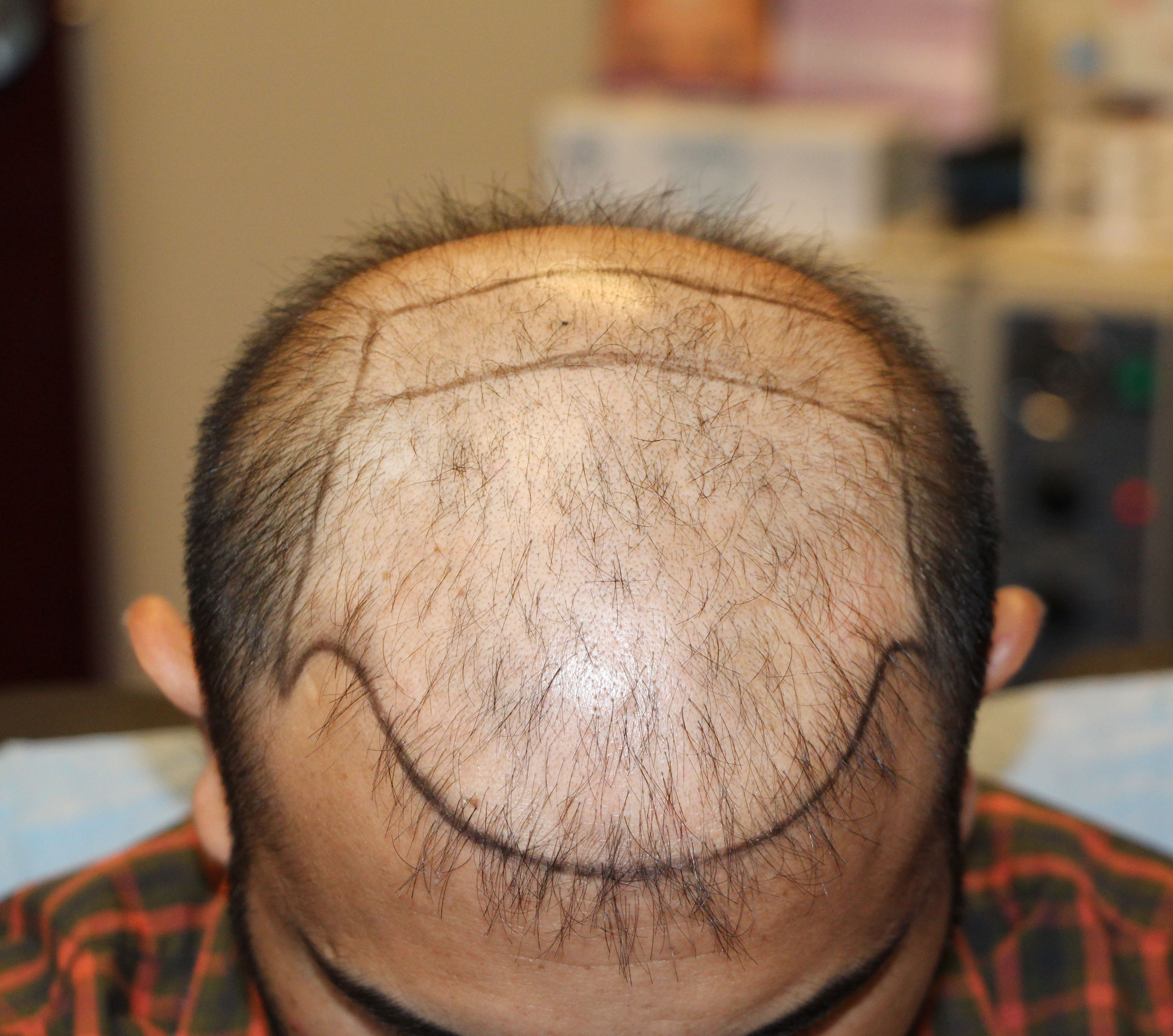 Botched Hair Transplant Repaired By Dr. Yazdan Modena Hair Institute