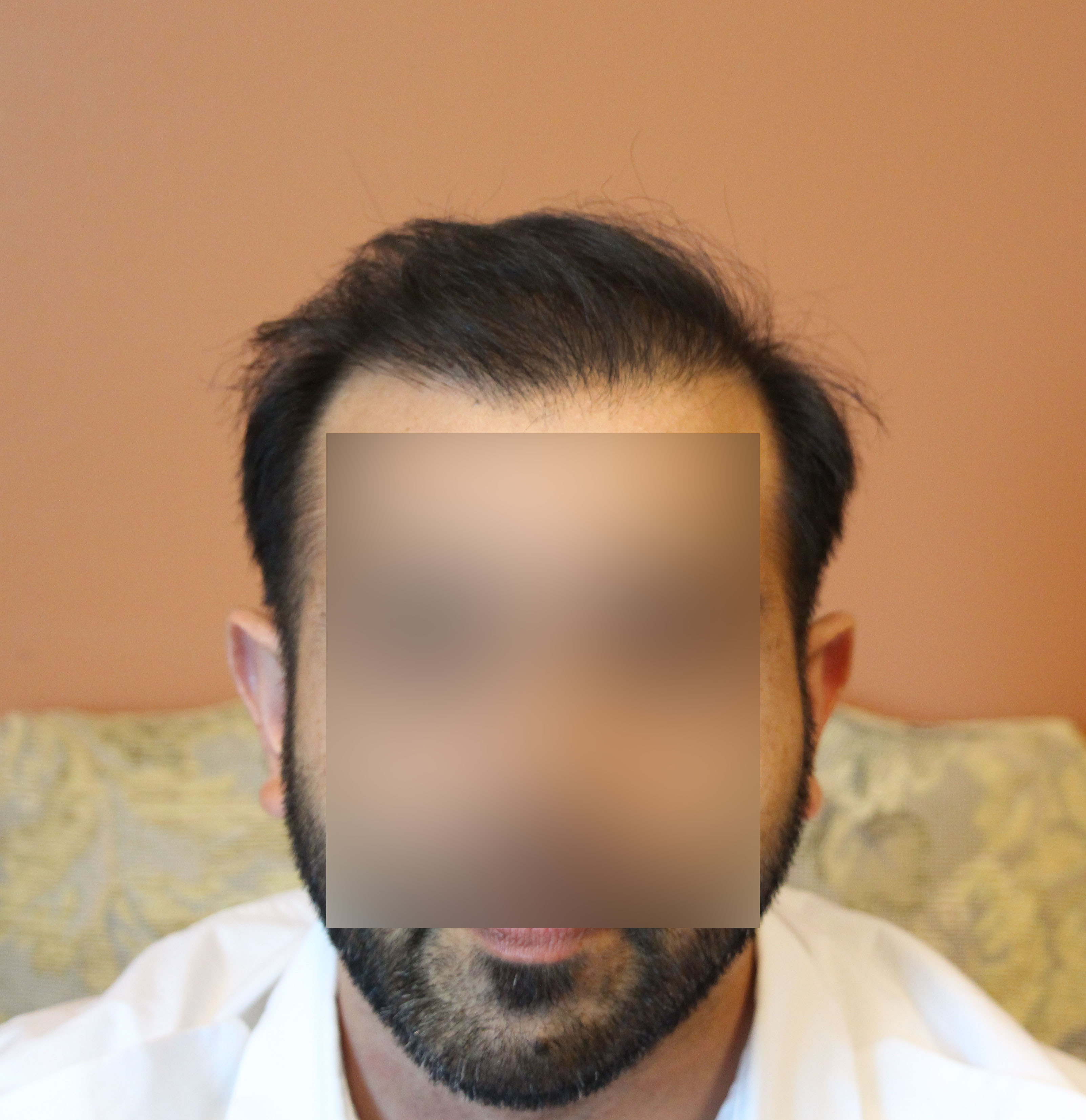 Botched Hair Transplant Repaired By Dr. Yazdan Modena Hair Institute