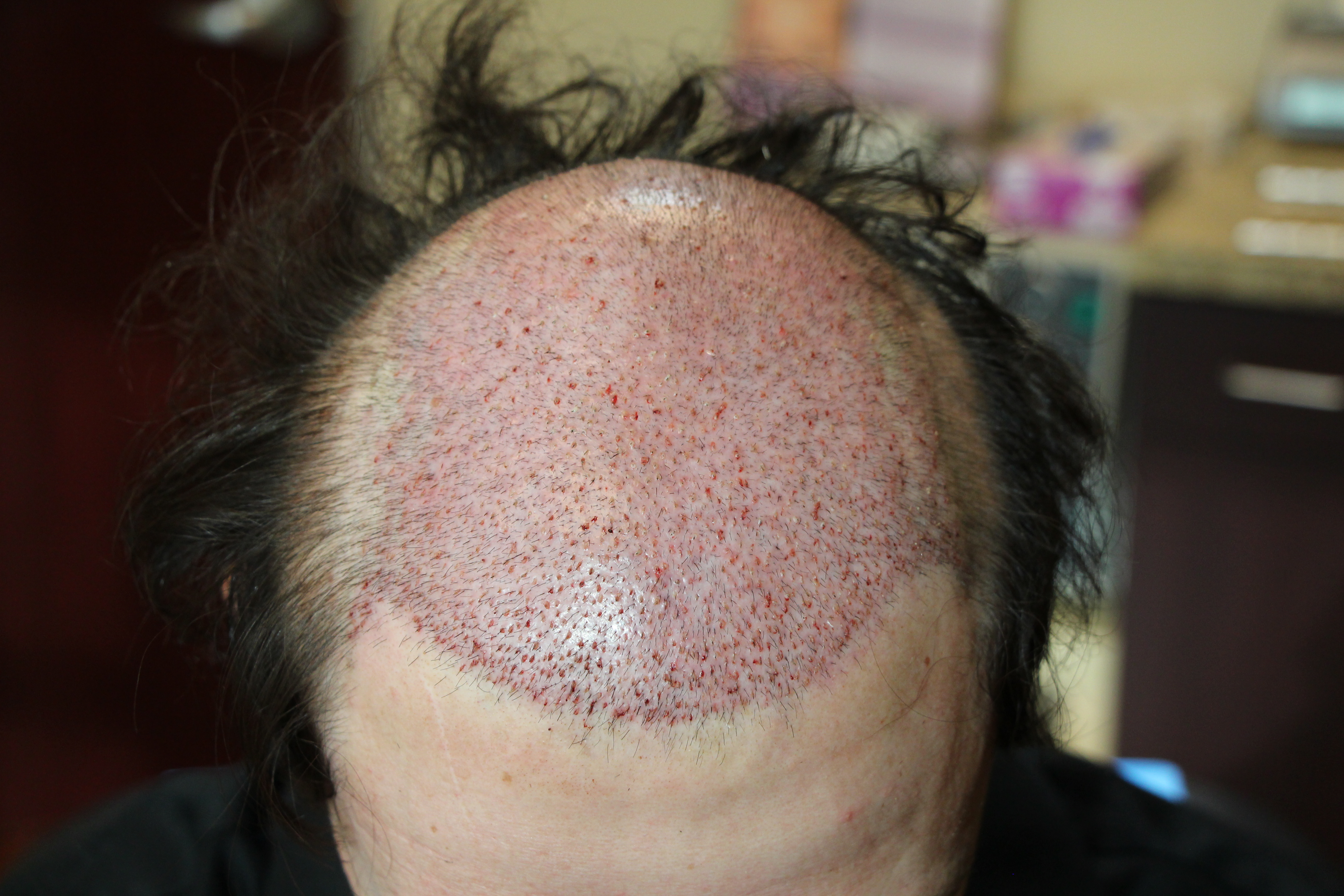 Case Study Botched Strip Transplant Corrected using FUE and Strip