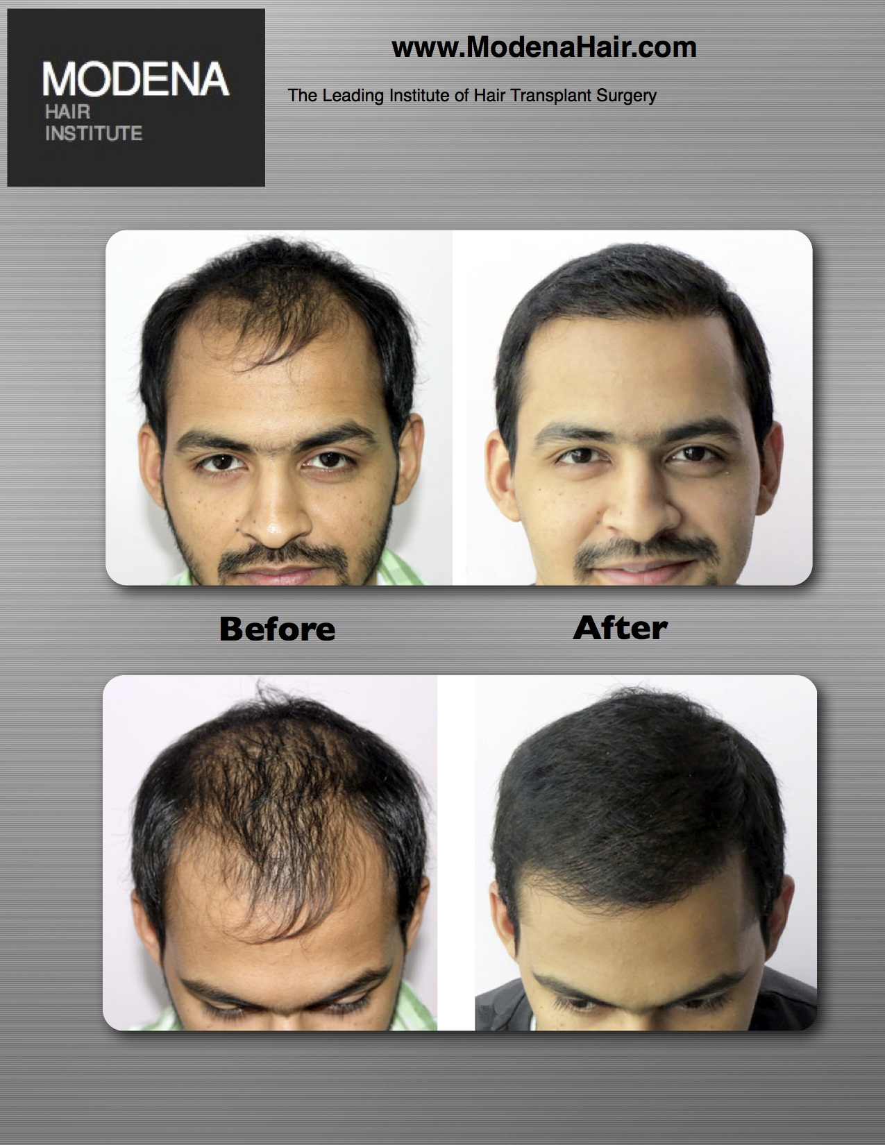 Las Vegas Hair Loss Treatment Hair Restoration Surgeon