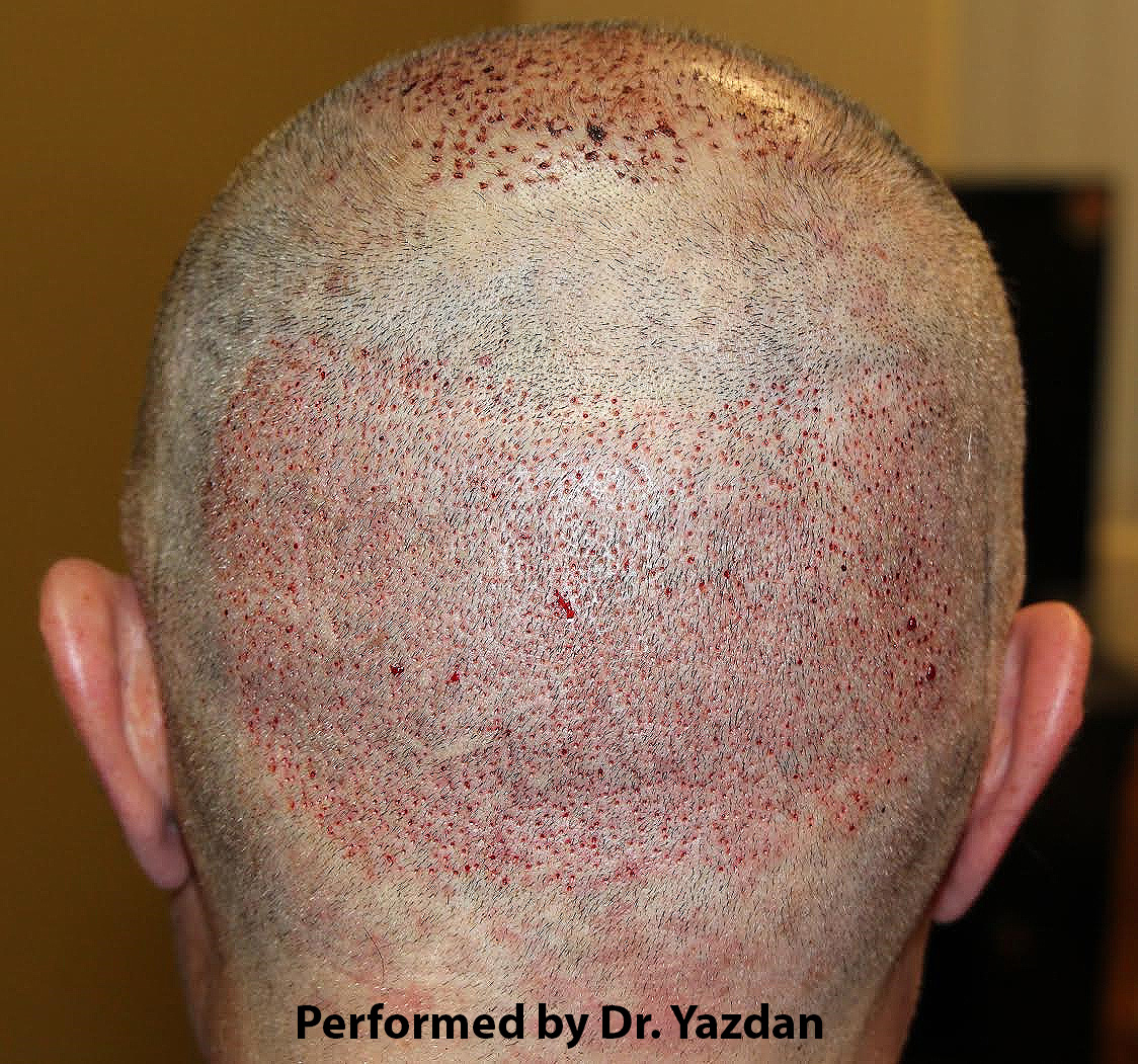 Botched Hair Transplant Careless Mistake Modena Hair Institute