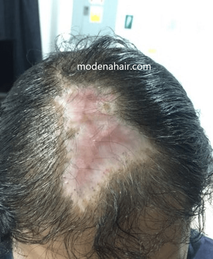 Turkey hair transplant surgery gone wrong Modena Hair Institute