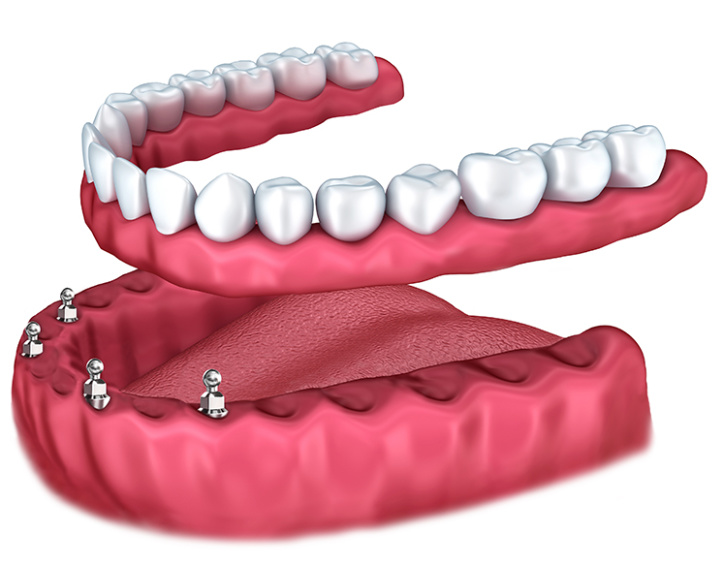 Dental Implants Boise Idaho Mini Dental Implants Boise ID