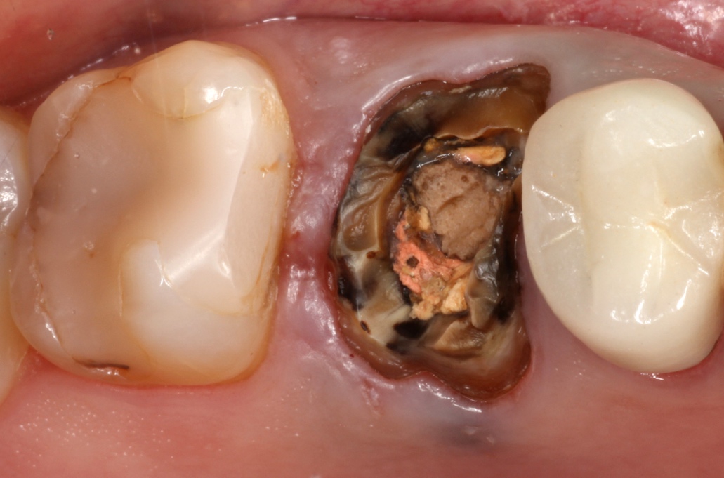 Dental Crowns + Bridges Richardson TX Dentist 972578MODE (6633)