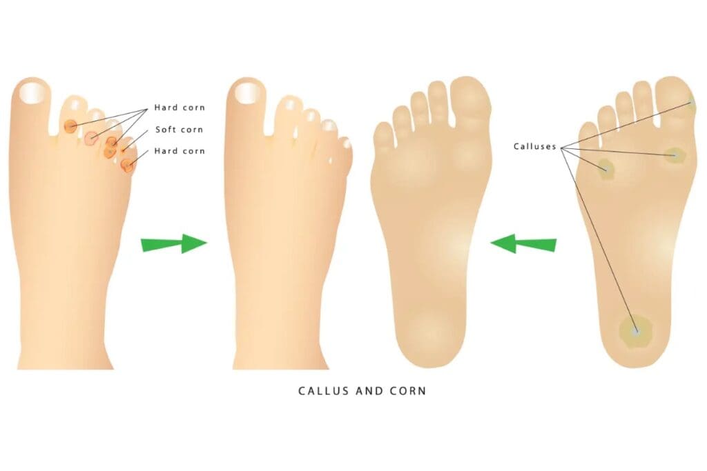 Corn and Callus Removal Modern Foot & Ankle