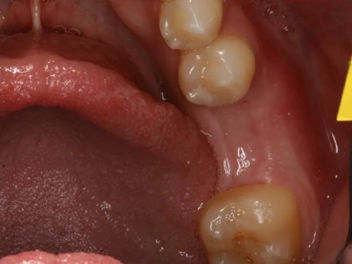 Bone Grafting Dental Implants Jacksonville