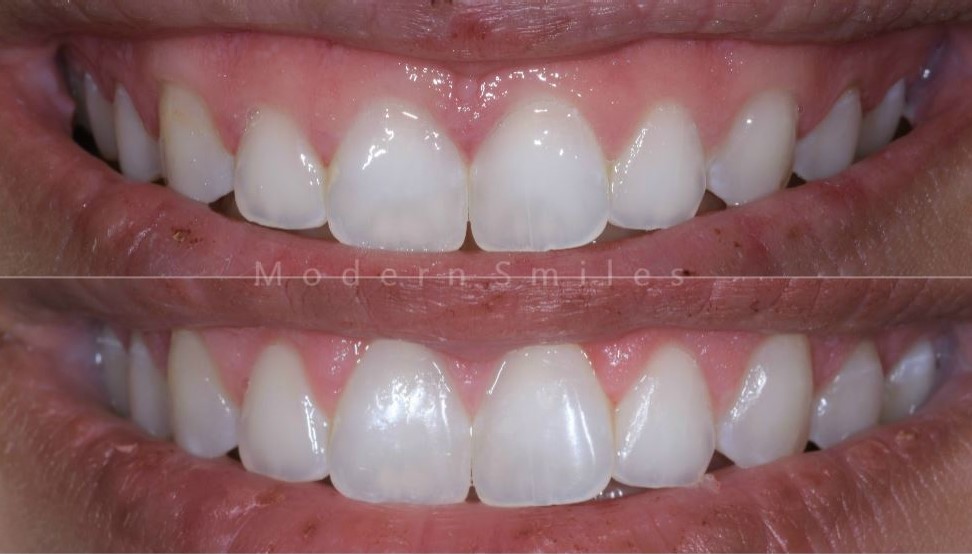 Gummy Smile Correction Modern Approach to Enhancing Your Smile