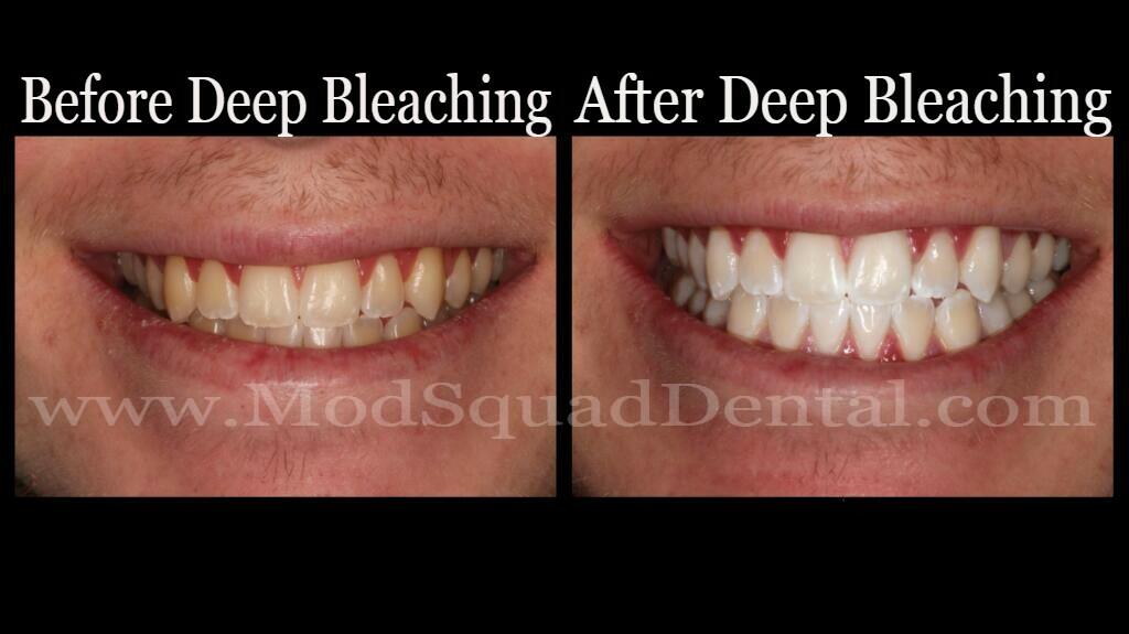 KOR Deep Bleaching The Number 1 Teeth Whitening Procedure
