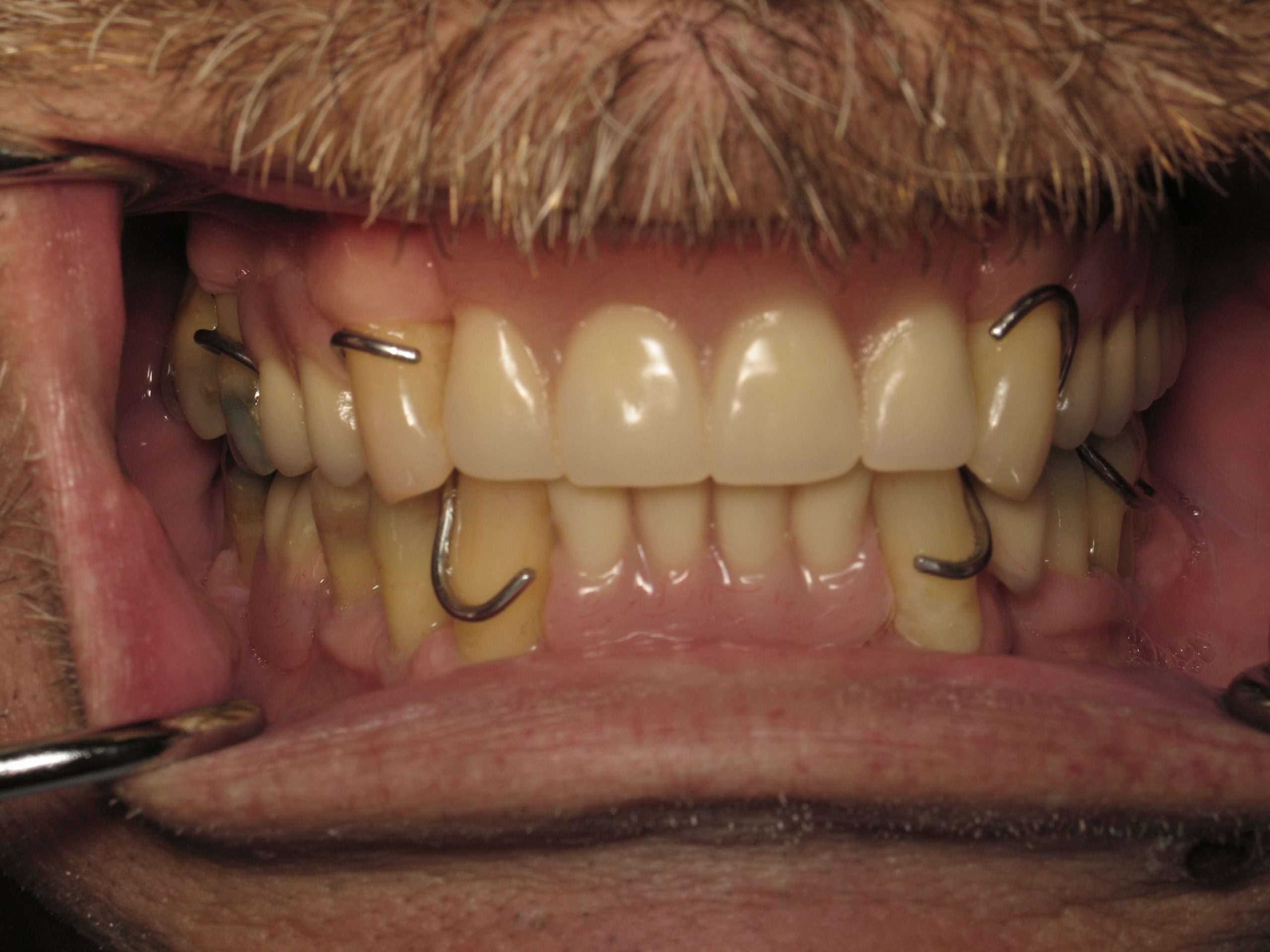 Smile Gallery Moffitt Restorative Dentistry Champlin, MN