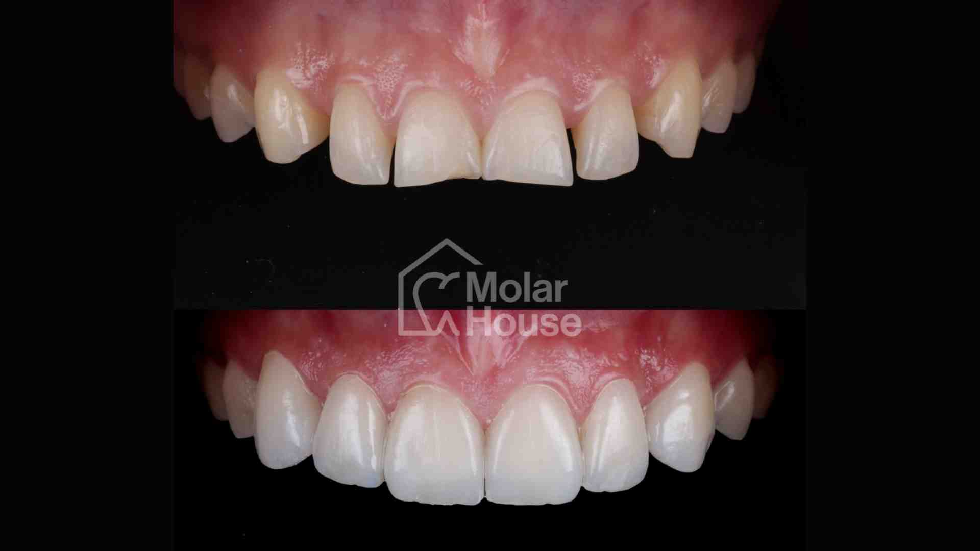 Veneers In Tijuana Molar House