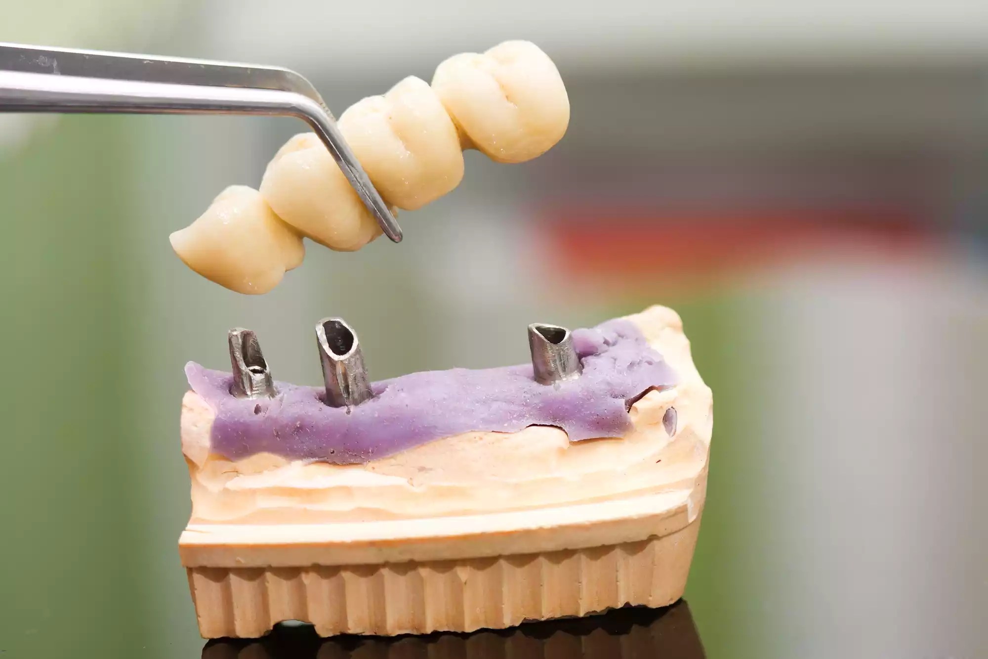 Effective Guide How to Clean a Dental Bridge Molar House