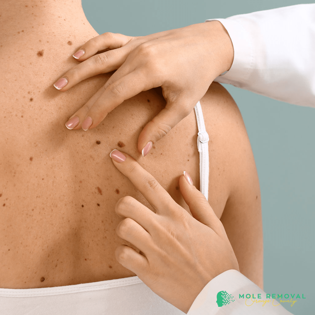 Everything You Need To Know About Our Mole Removal Process