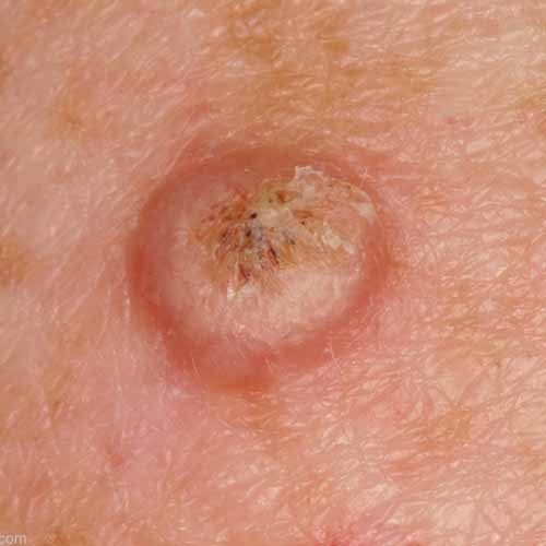 Skin Cancer Melanoma Signs and Symptoms Skin cancer images and