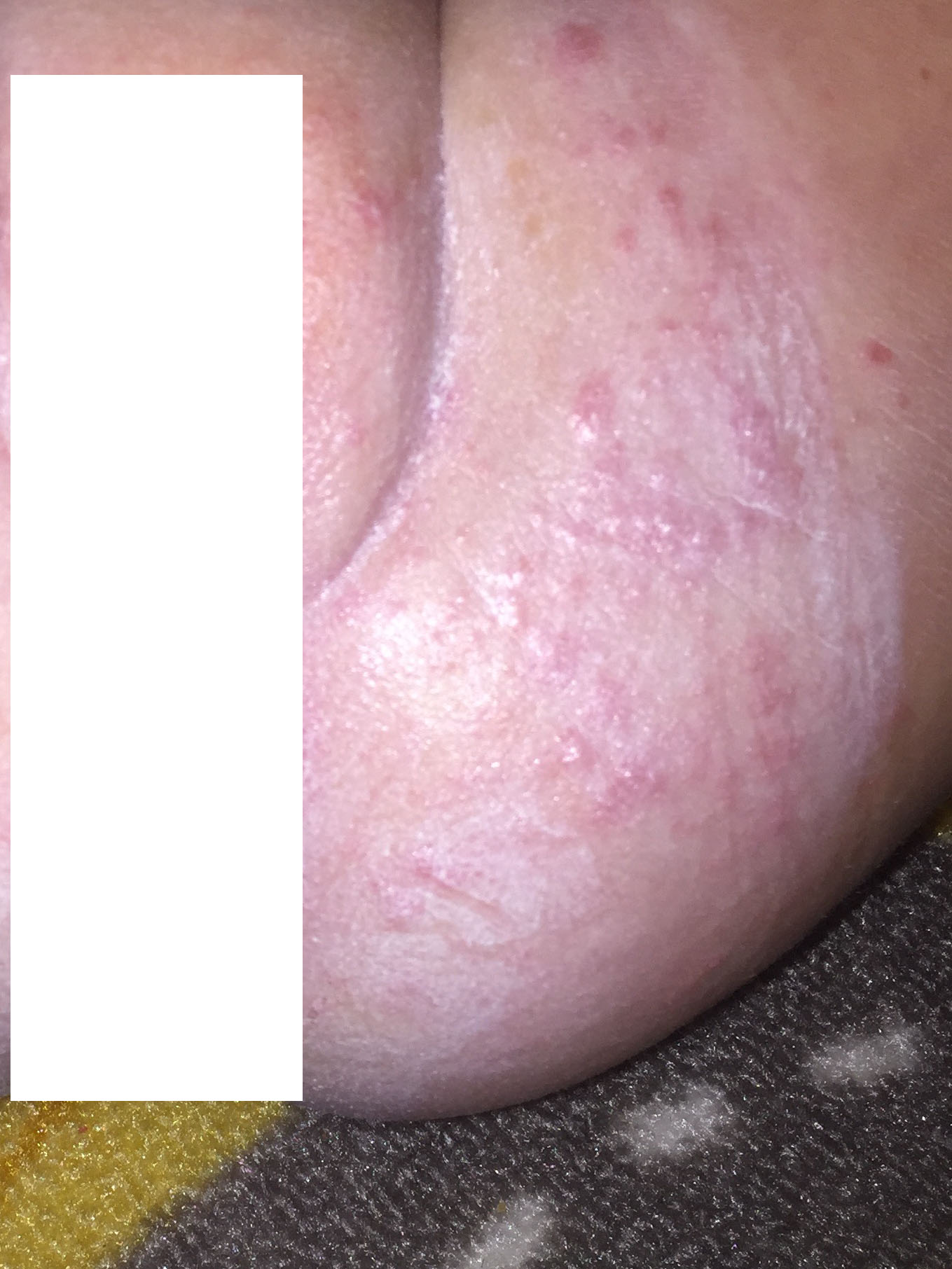 Hand, Foot, and Mouth Disease It’s not Pretty! Momming