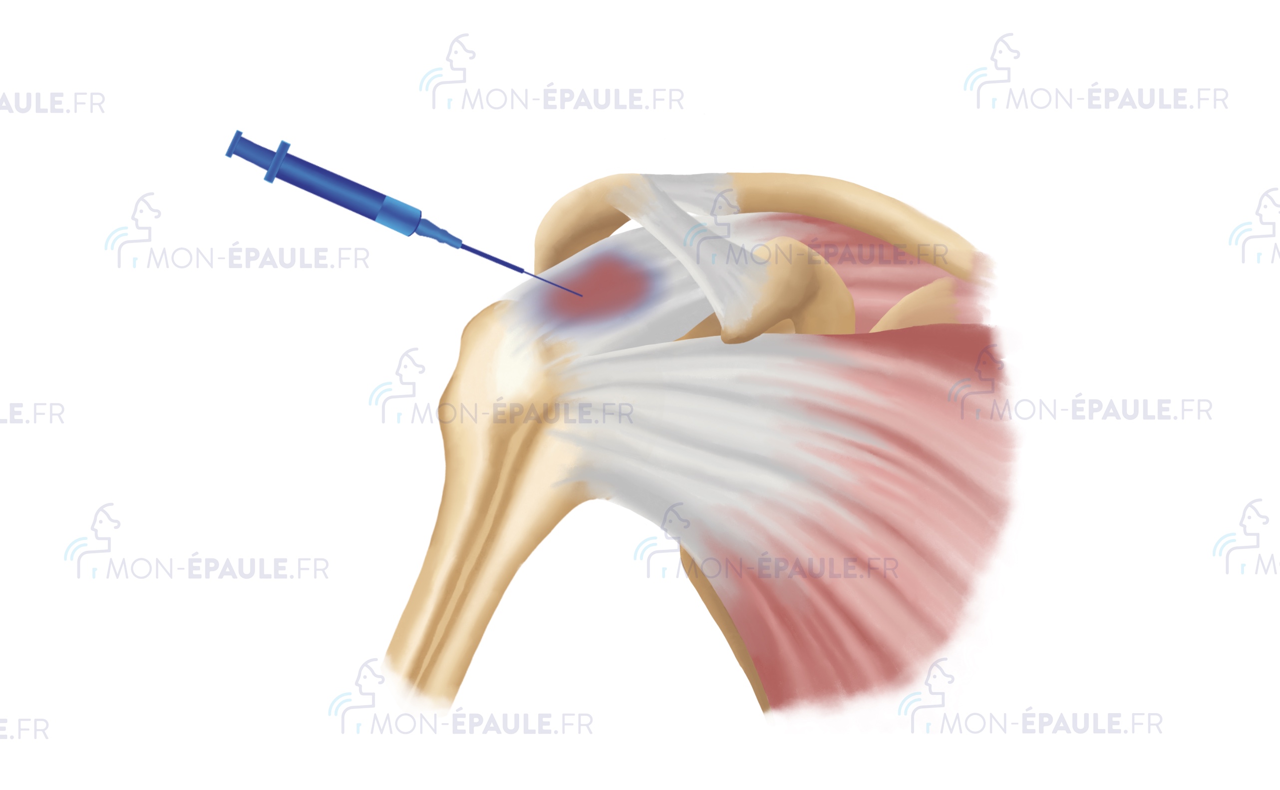 Les infiltrations à l'épaule, au coude et au genou Mon Épaule