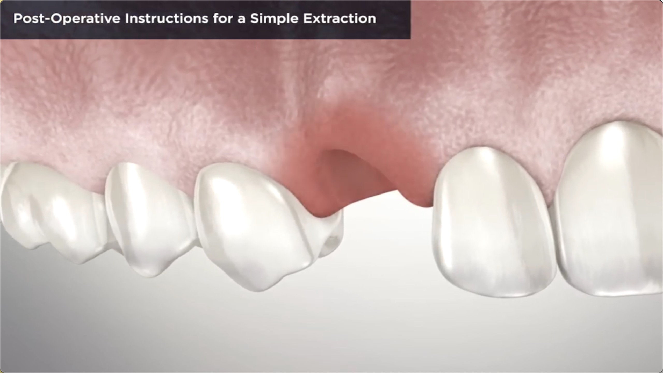 Tooth Extraction Burlington NC Monahan Family Dentistry