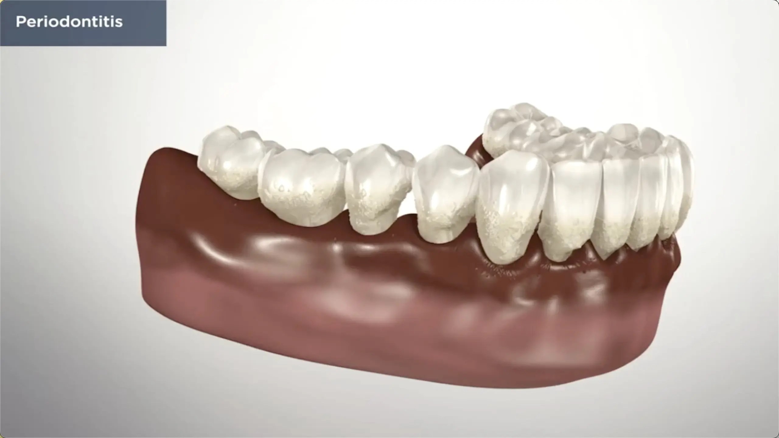 Periodontal Therapy Burlington NC Monahan Family & Cosmetic