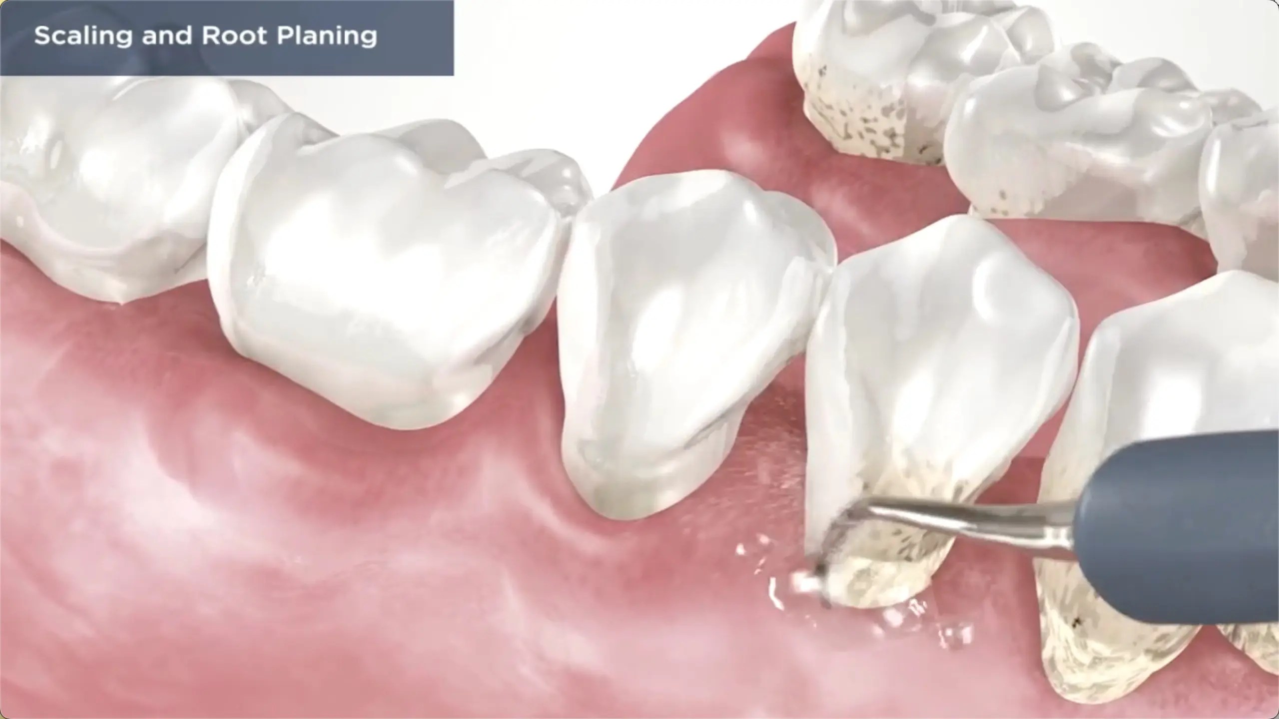 Periodontal Therapy Burlington NC Monahan Family & Cosmetic