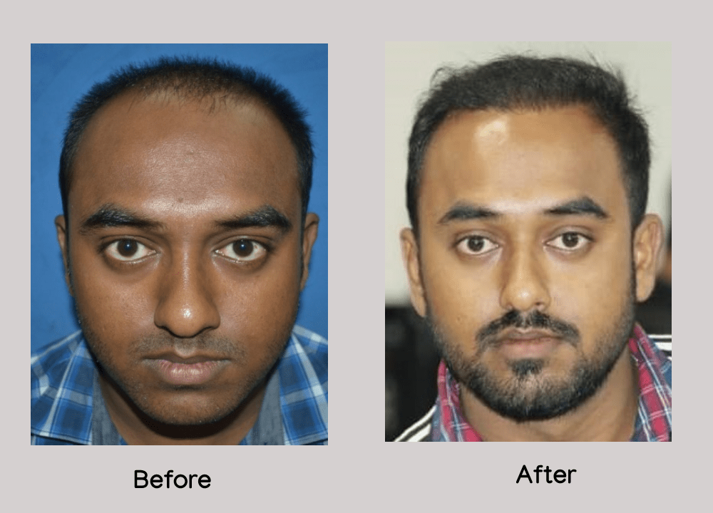 Monjoven Hair Transplant & Cosmetic Surgery Clinic