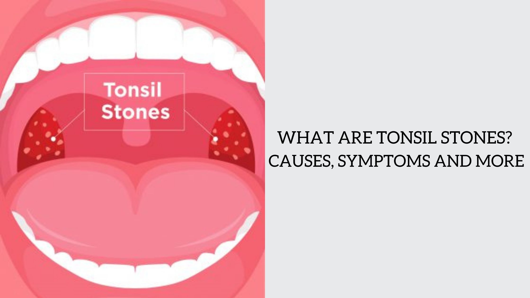 WHAT ARE TONSIL STONES? CAUSES, SYMPTOMS AND MORE 'Monomousumi'