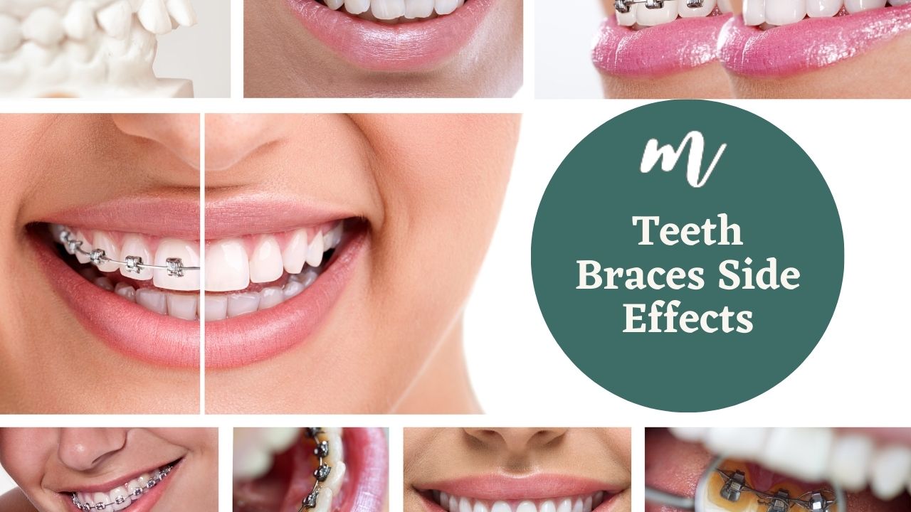 How Do Braces Work? Types, Cost, & Side Effects