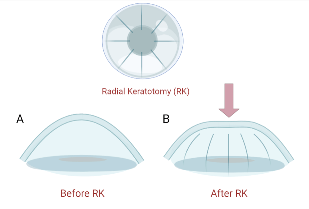Radial Keratotomy