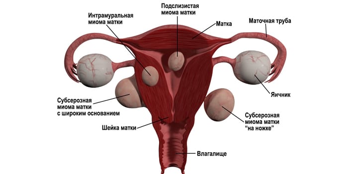 Что Такое Киста Матки Фото