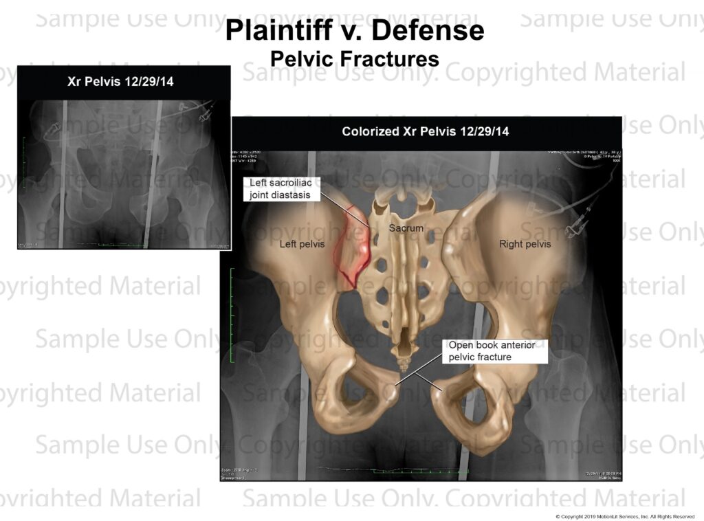 Pelvis Fracture Xray Interpretation MotionLit