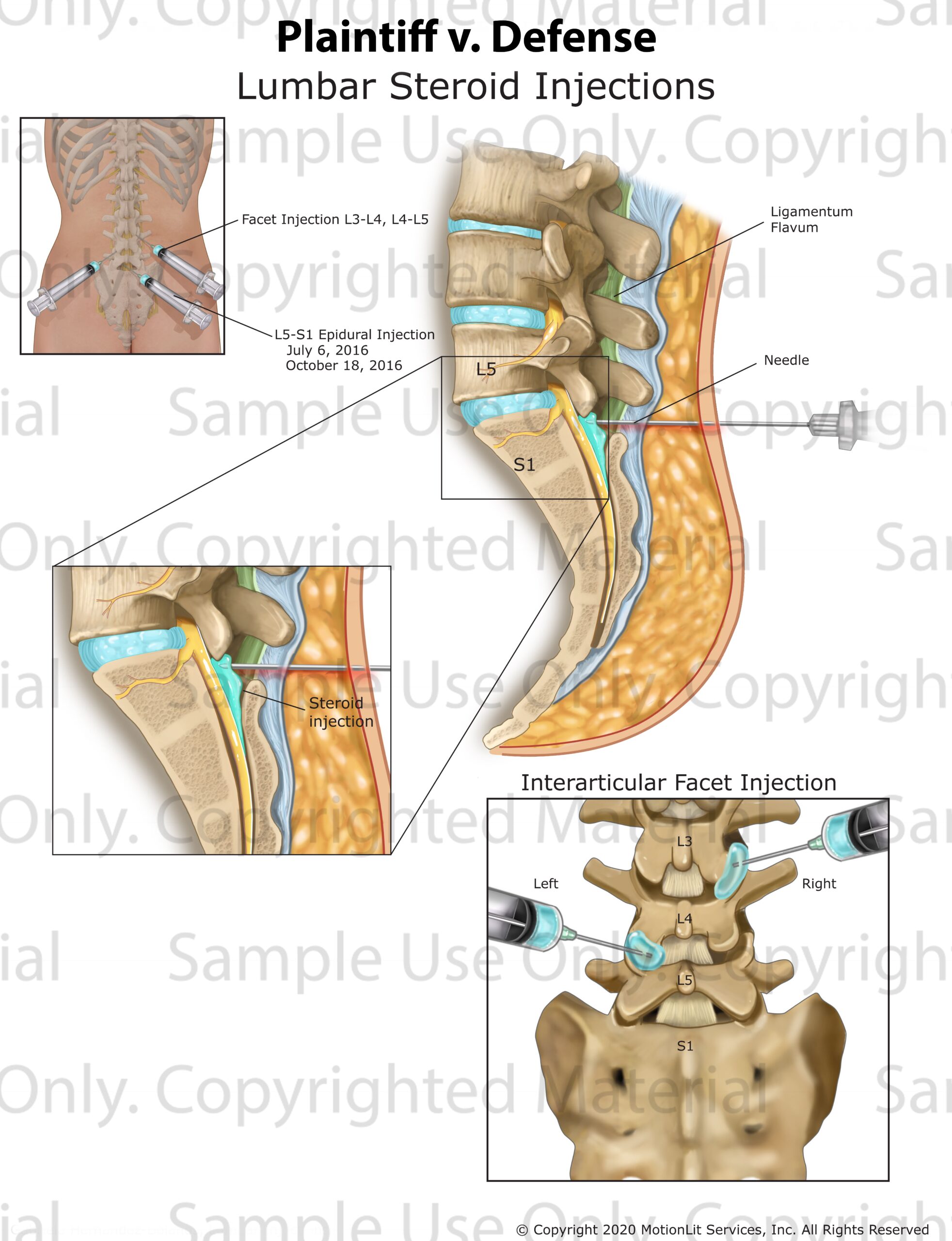 Epidural Injection S1 MotionLit