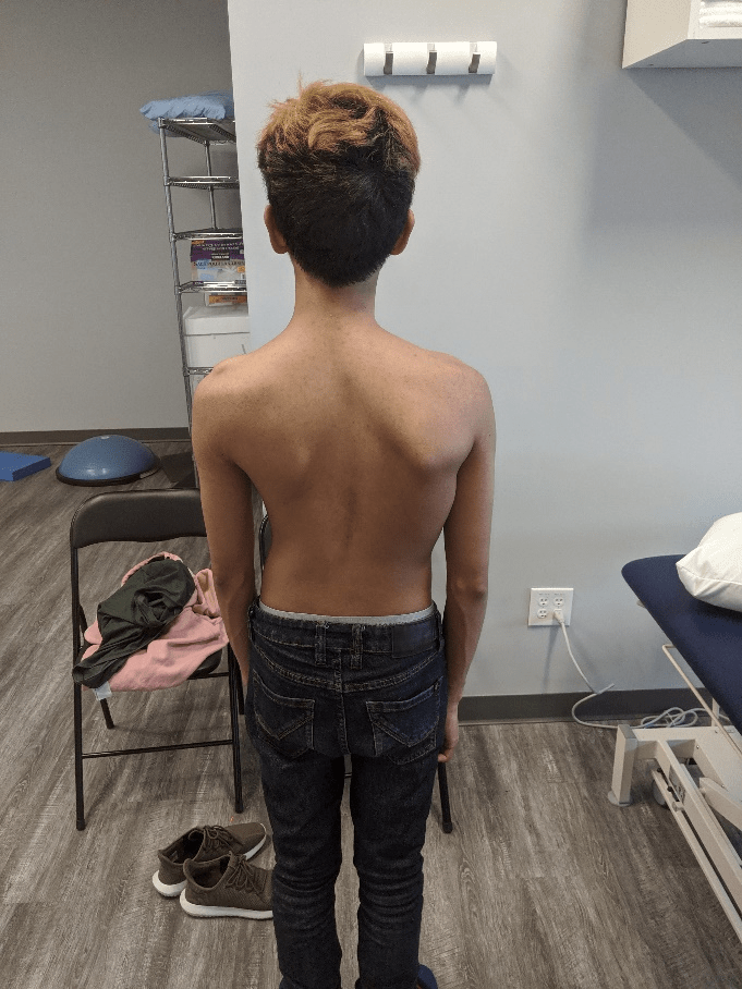 Back Pain Scoliosis Motion Science Physiotherapy Clinic