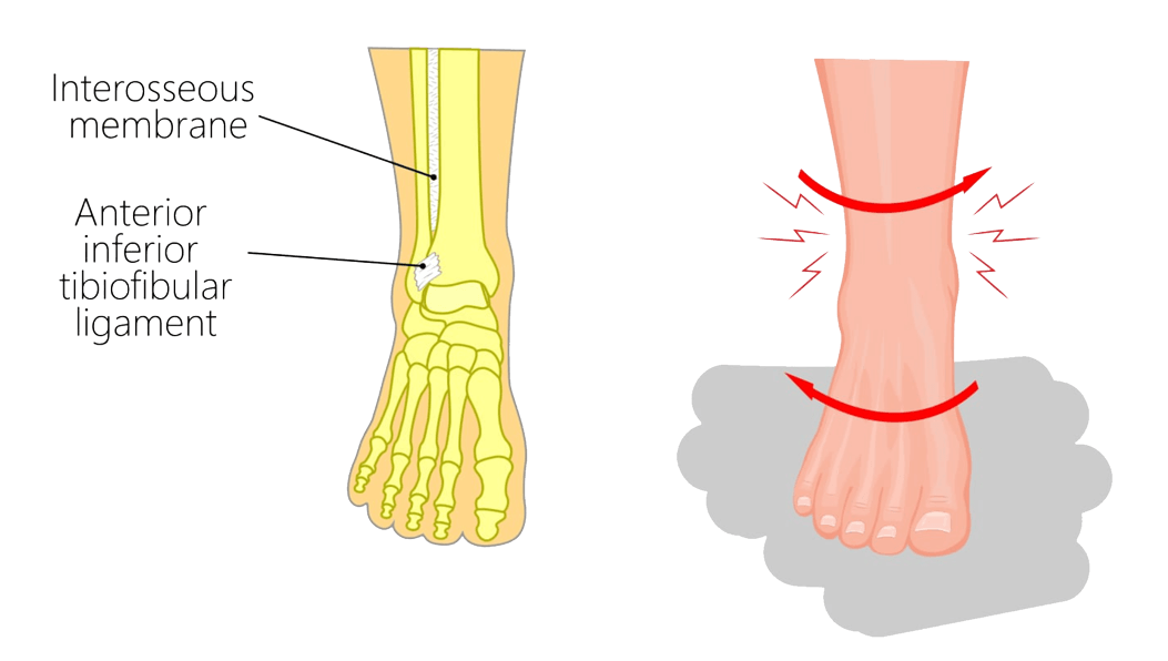 High Ankle Sprain MOTUS Physical Therapy