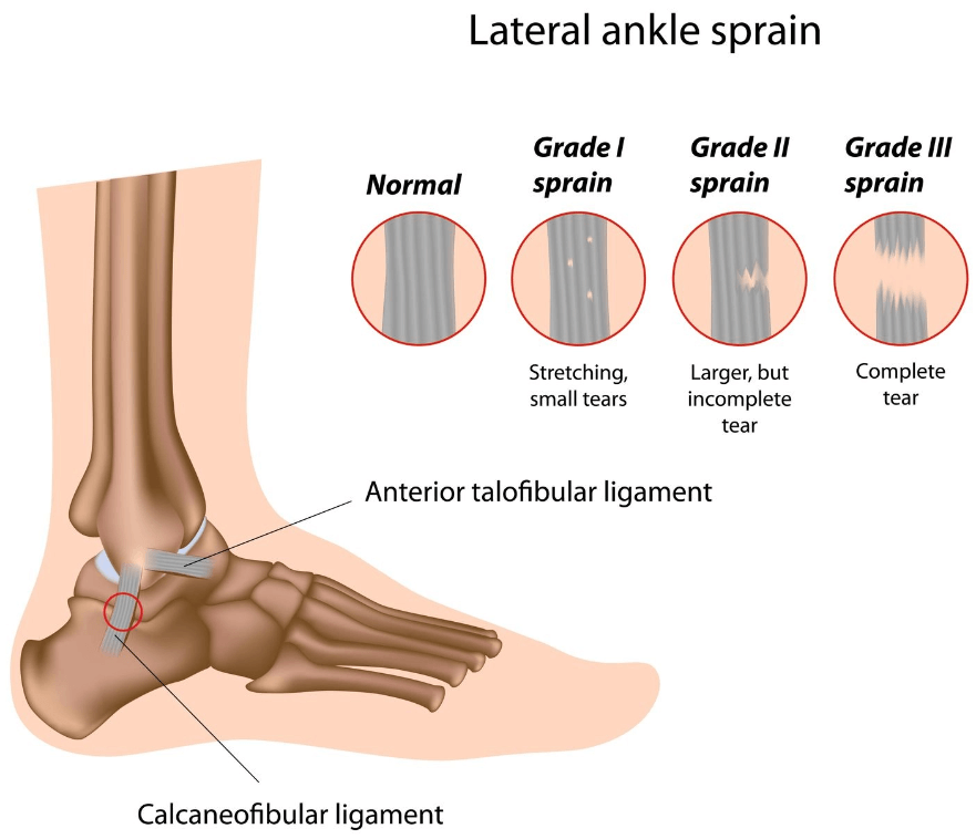 Lateral Ankle Sprain MOTUS Physical Therapy