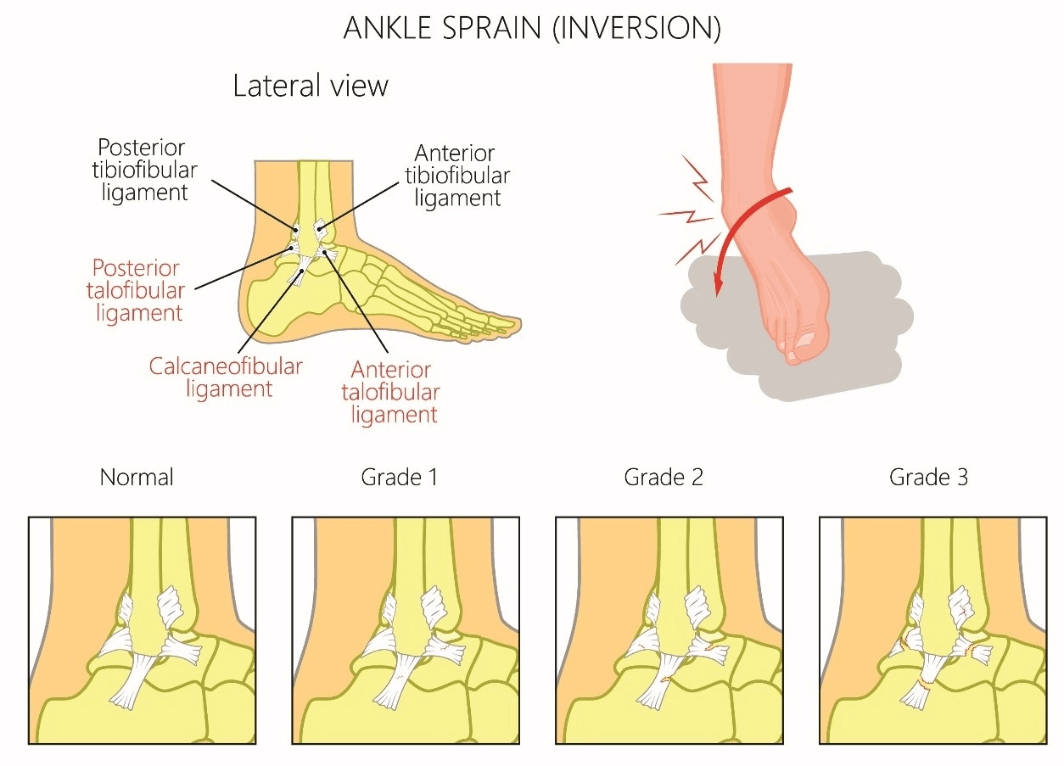 Lateral Ankle Sprain MOTUS Physical Therapy