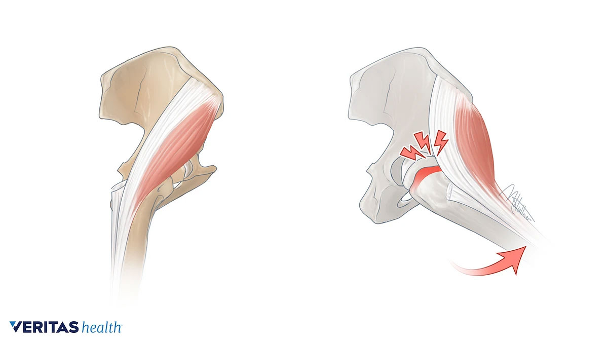 Snapping Hip Syndrome Motus Physical Therapy