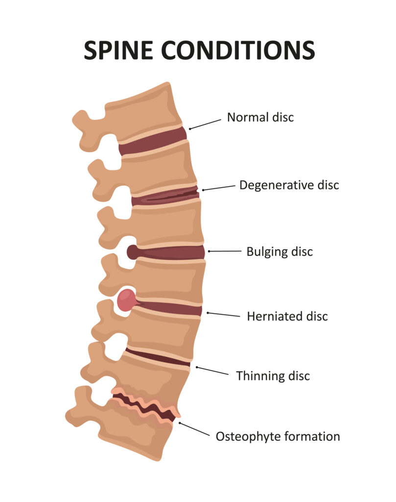 What Can Help Degenerative Disc Disease at Tina Squires blog