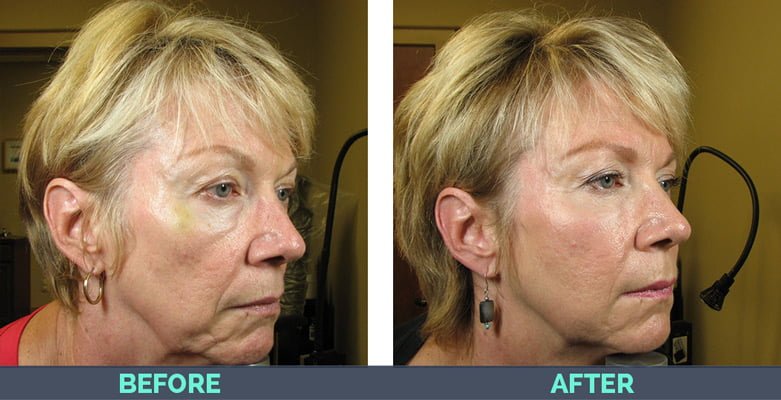 Platelet Rich Plasma (PRP) Facial Rejuvenation Asheville, NC